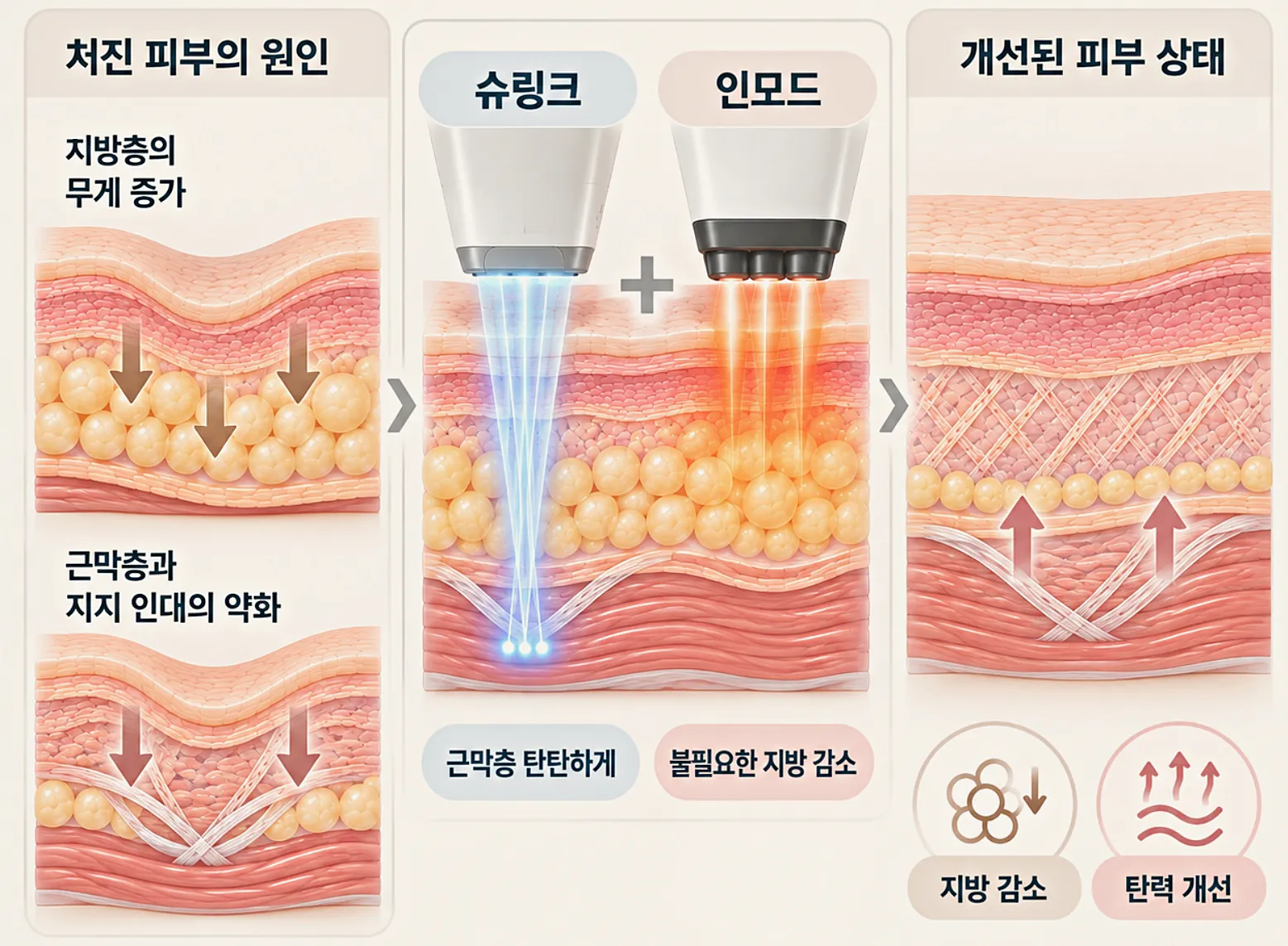 슈링모드 구성 - 층과 방식이 모두 다른 인모드와 슈링크 관계도