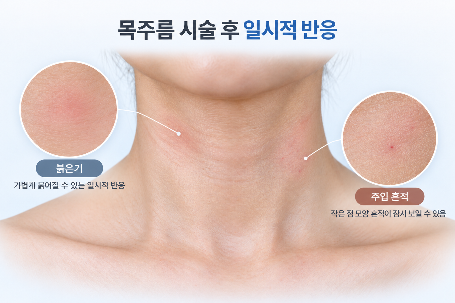 목주름 시술 후 목 피부에 나타난 붉은기와 작은 주입 흔적