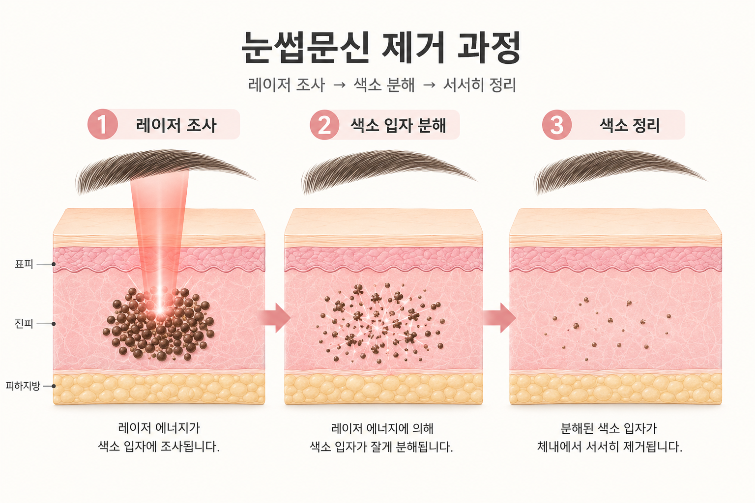 눈썹문신 제거 시 레이저 조사부터 색소 입자 분해와 정리까지의 3단계 과정