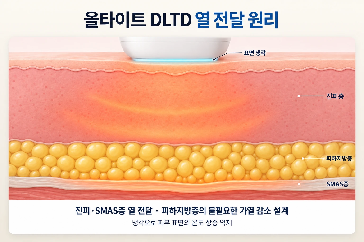 올타이트 DLTD의 진피층·SMAS층 열 전달과 피하지방층의 상대적 가열 감소 설계 및 피부 표면 냉각