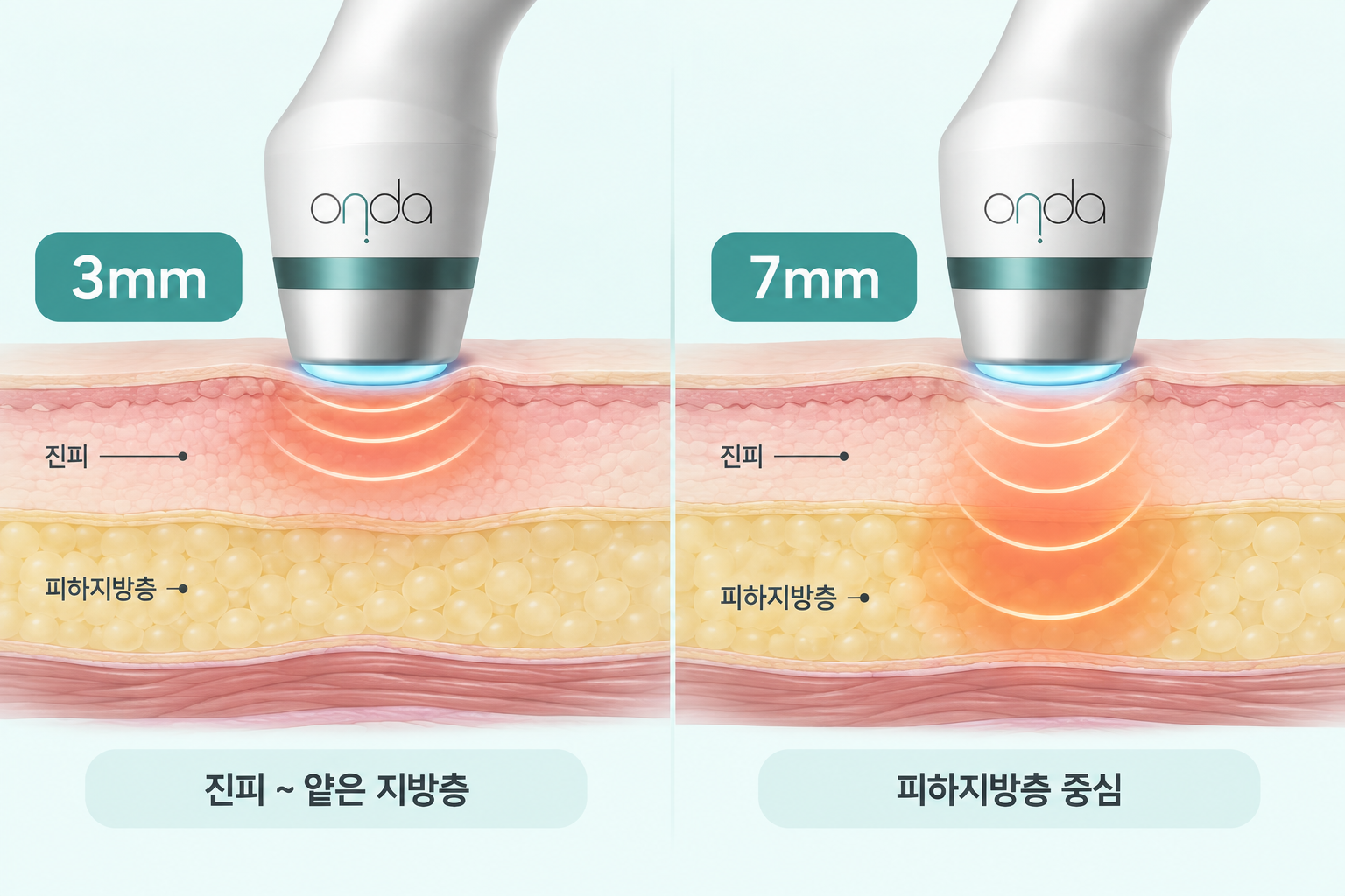 온다리프팅 3mm와 7mm 핸드피스의 진피 및 피하지방층 에너지 전달 깊이 비교