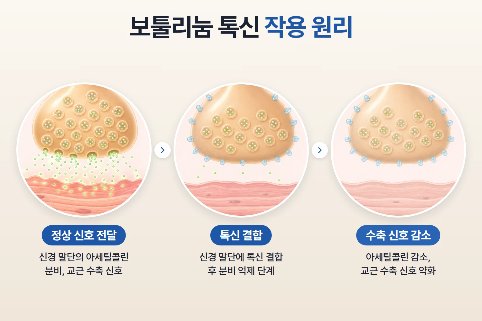 신경 말단의 아세틸콜린 분비, 톡신 결합, 교근 수축 신호 감소를 단계별로 나타낸 개념도