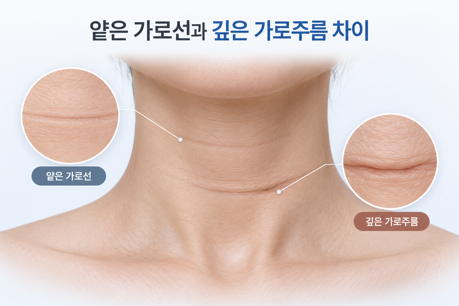 얕은 가로선과 깊게 자리 잡은 목주름의 깊이 차이