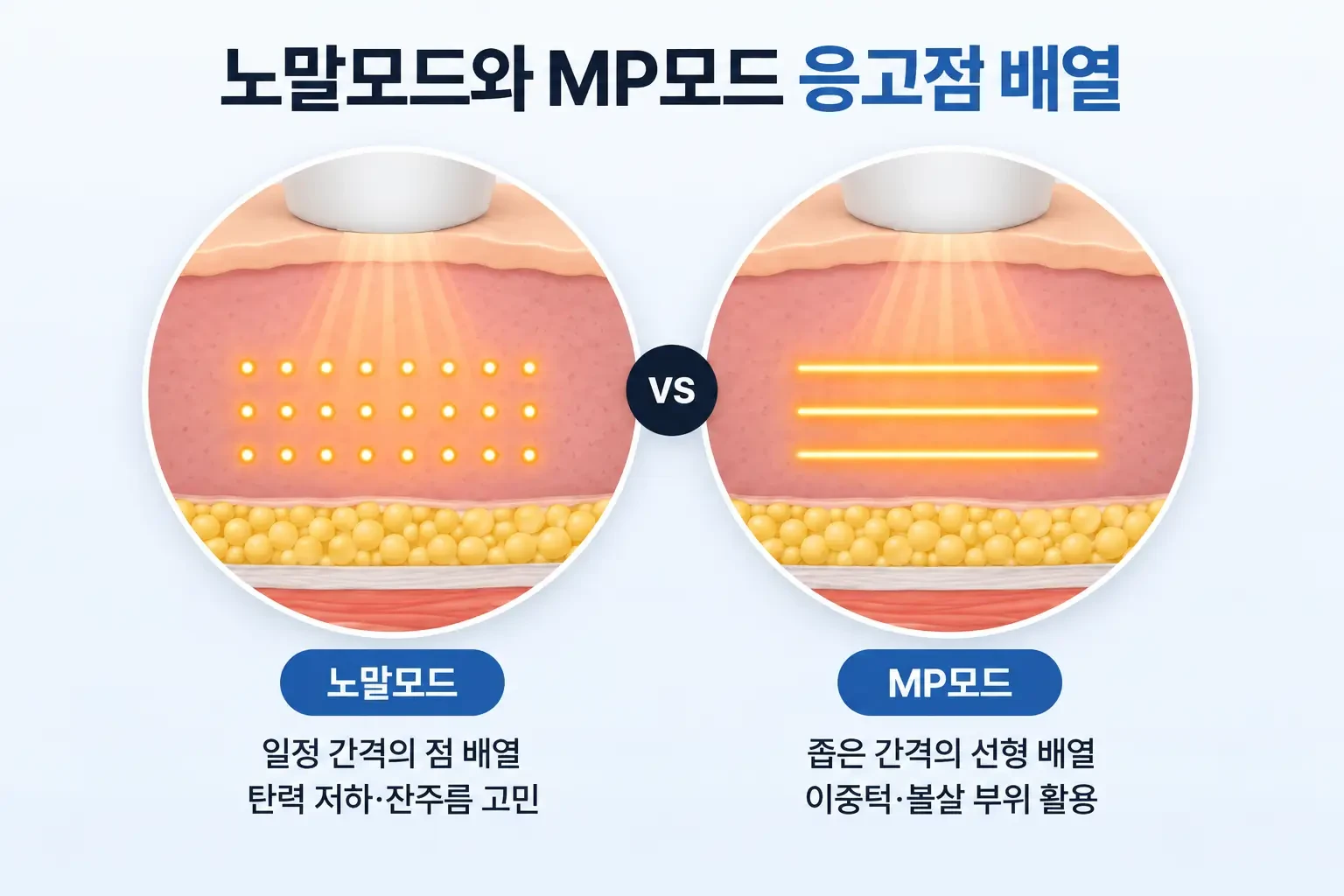 일정 간격의 노말모드 점 응고점과 좁은 간격으로 이어진 MP모드 응고점 배열을 비교한 도식