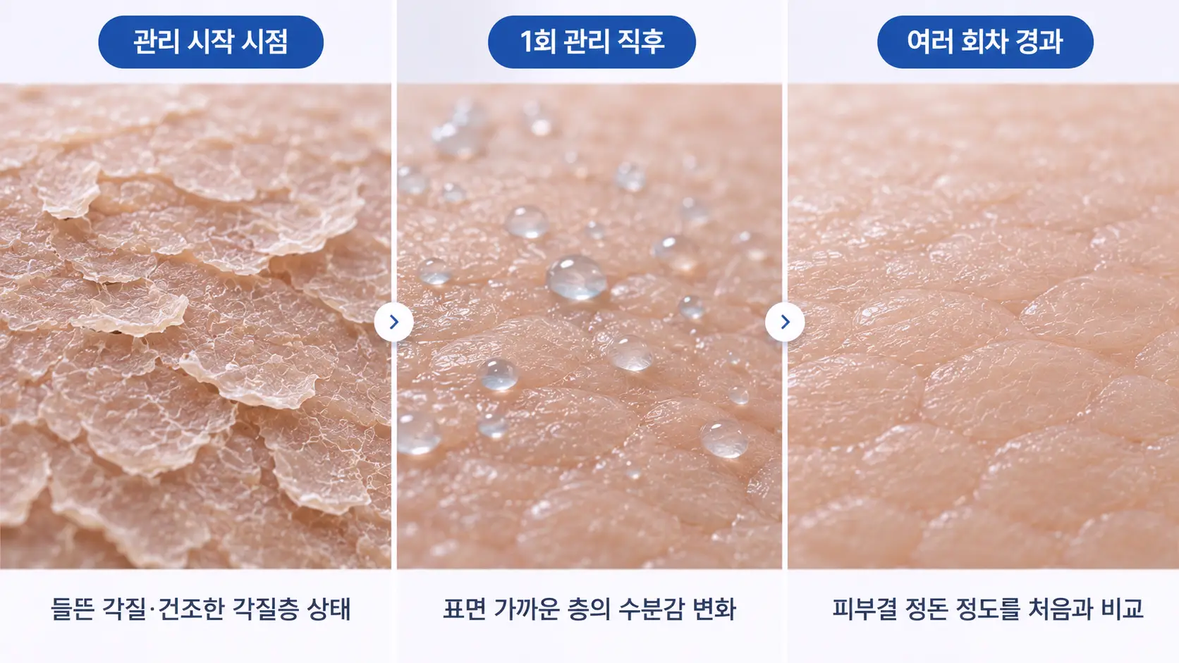 건조한 각질층, 1회 관리 직후 수분감, 여러 회차 뒤 정돈된 피부결을 단계별로 나타낸 일러스트