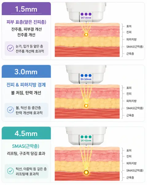 울쎄라 300샷 시 활용되는 깊이별 초음파 에너지