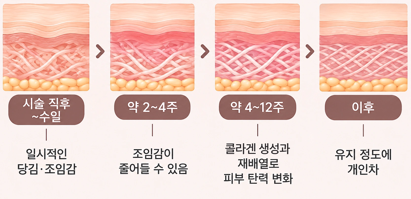 티타늄리프팅 시술 직후부터 2~4주, 4~12주 이후까지 콜라겐 재형성과 피부 탄력 변화 과정을 나타낸 피부 단면도