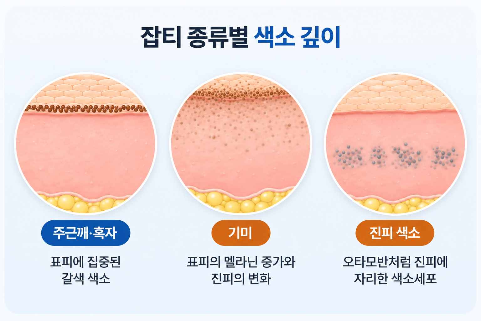 주근깨·흑자의 표피 멜라닌 집중, 기미의 표피 색소 증가와 진피 변화, 오타모반 등 진피 색소의 위치를 비교한 피부 단면