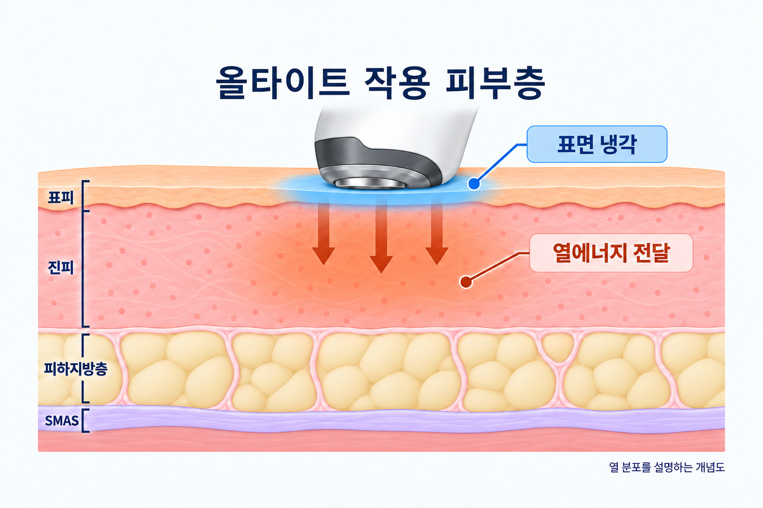 올타이트 리프팅 시 피부 표면 냉각과 진피층 및 피하지방층으로 열에너지가 전달되는 원리를 설명한 피부 단면도