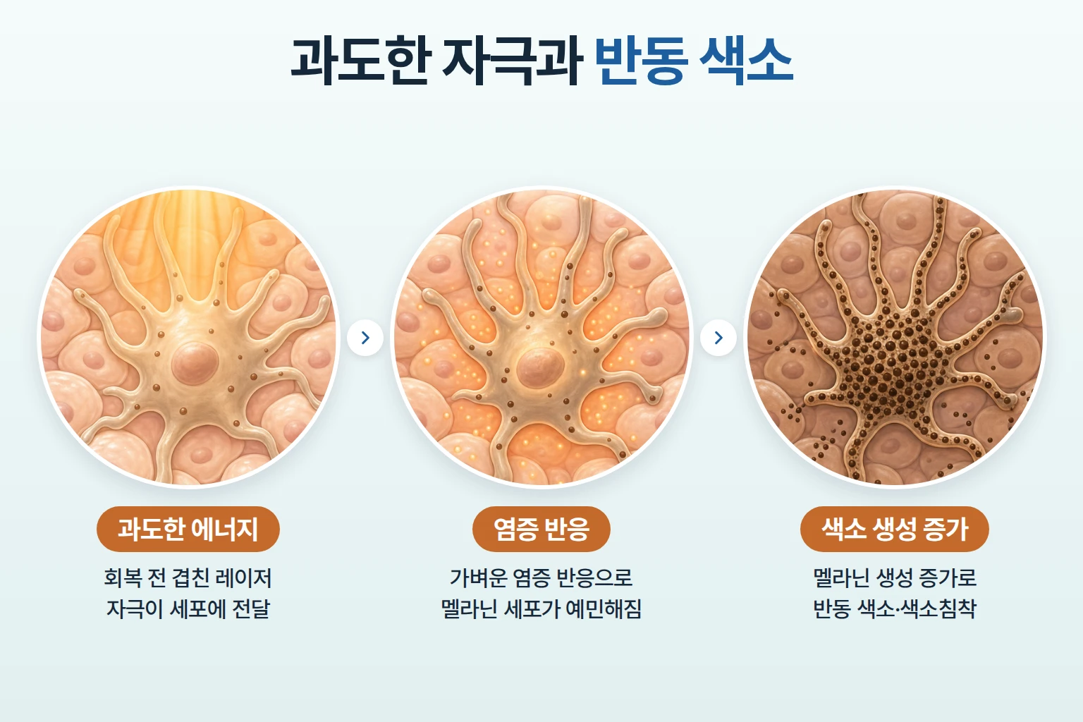 과도한 레이저 자극, 염증 반응, 멜라닌 세포의 색소 생성 증가를 단계별로 확대해 나타낸 개념도