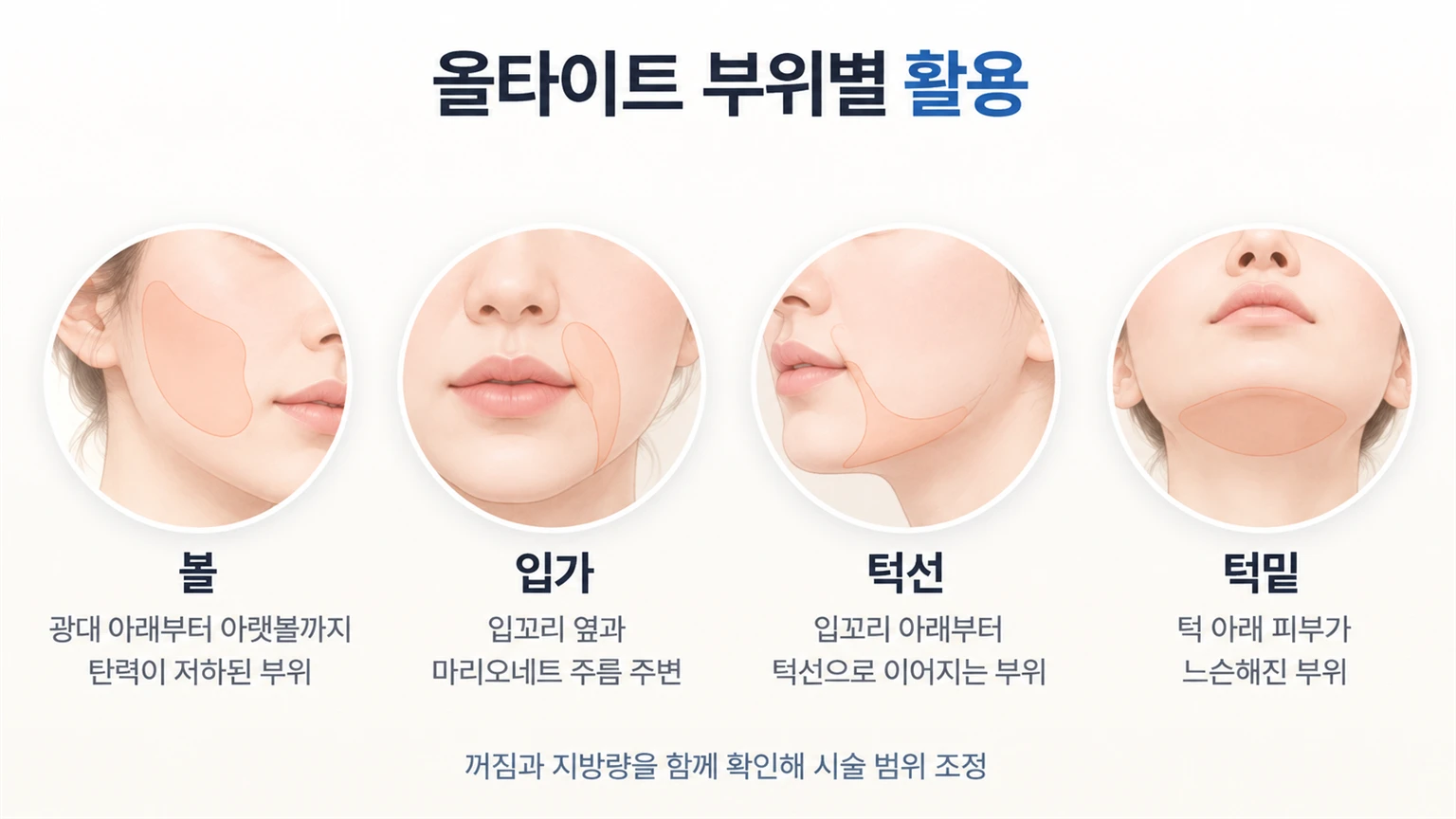 광대 아래 볼, 입꼬리 옆 마리오네트 주름, 턱선과 턱밑의 올타이트 활용 부위를 구분한 네 영역