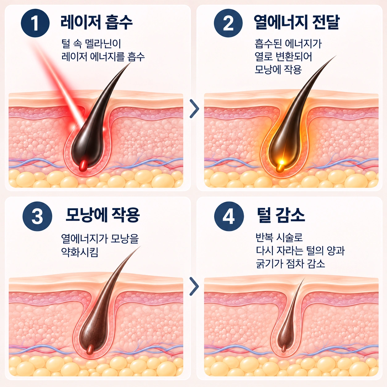 레이저 에너지가 모낭에 작용해 털이 감소하는 과정