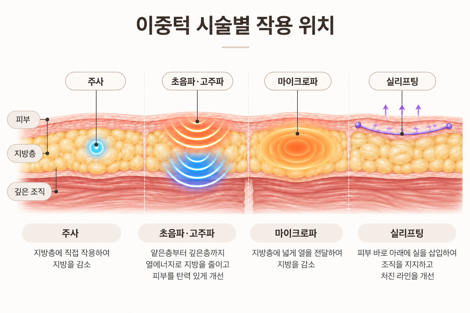 이중턱 주사 초음파 고주파 마이크로파 실리프팅의 피부층 작용 위치