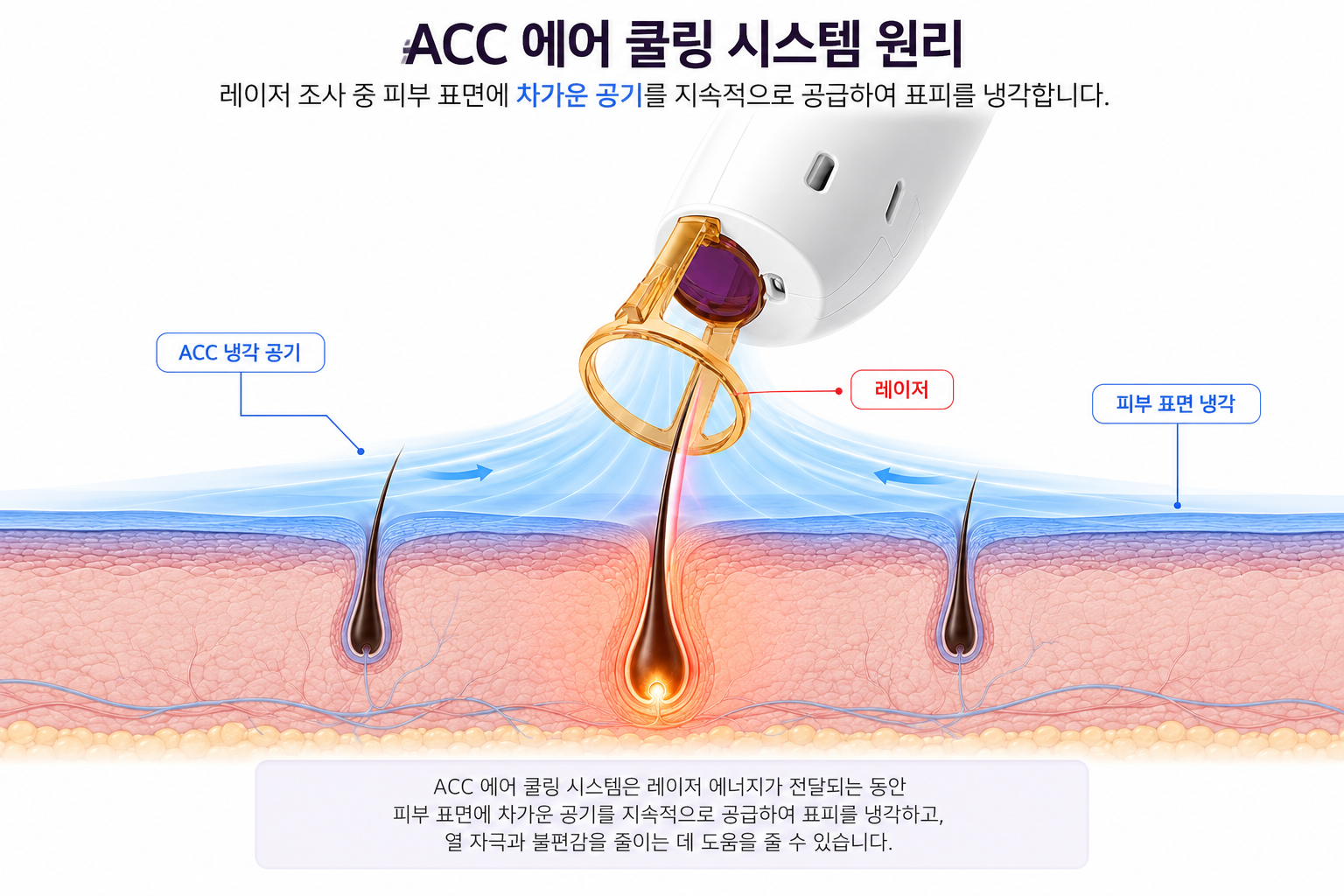 대전 레이저 제모 ACC 에어 쿨링이 피부 표면을 냉각하고 레이저가 모낭에 작용하는 원리
