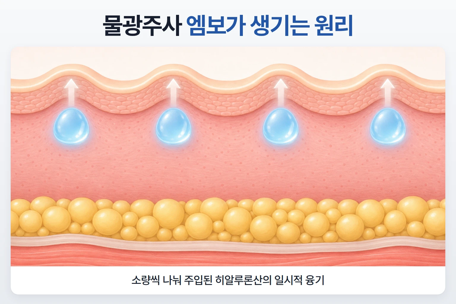 진피층에 일정 간격으로 소량씩 주입된 히알루론산 방울이 피부 표면을 작게 밀어 올린 단면도