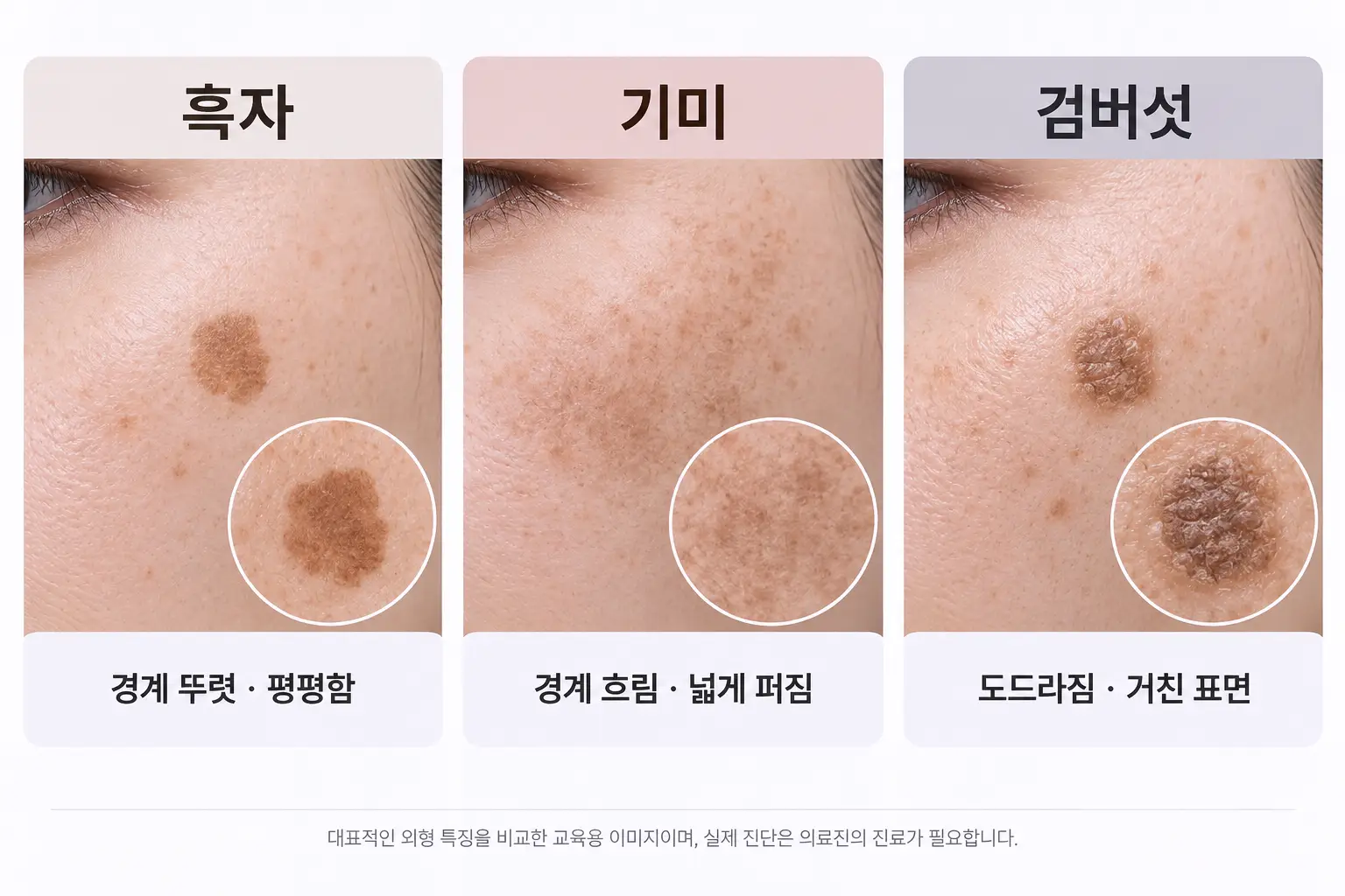 흑자 기미 검버섯의 경계와 표면 차이를 비교한 피부 색소 일러스트