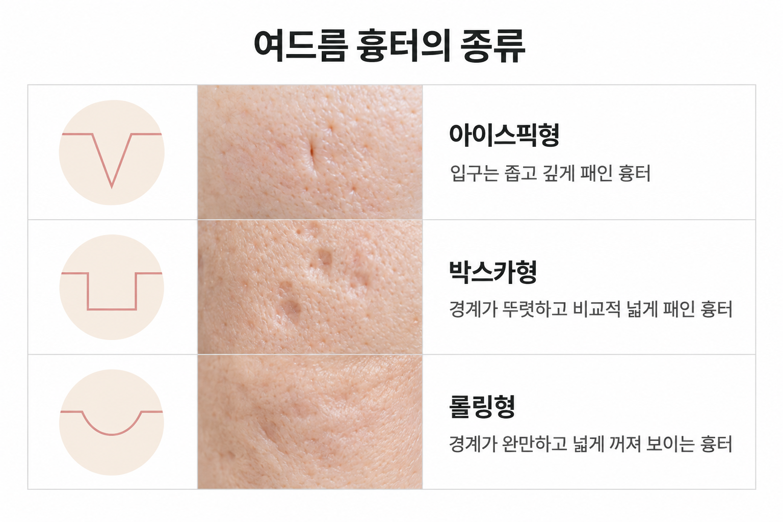 아이스픽형 박스카형 롤링형 패인 여드름 흉터 유형 비교