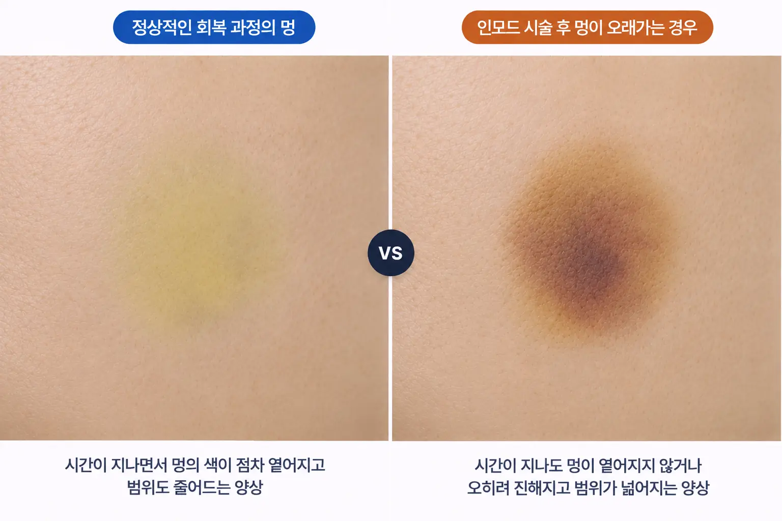 인모드 멍이 빠진 자리의 노란빛 잔멍과 옅은 갈색 색소침착을 같은 배율로 비교한 피부 확대 사진
