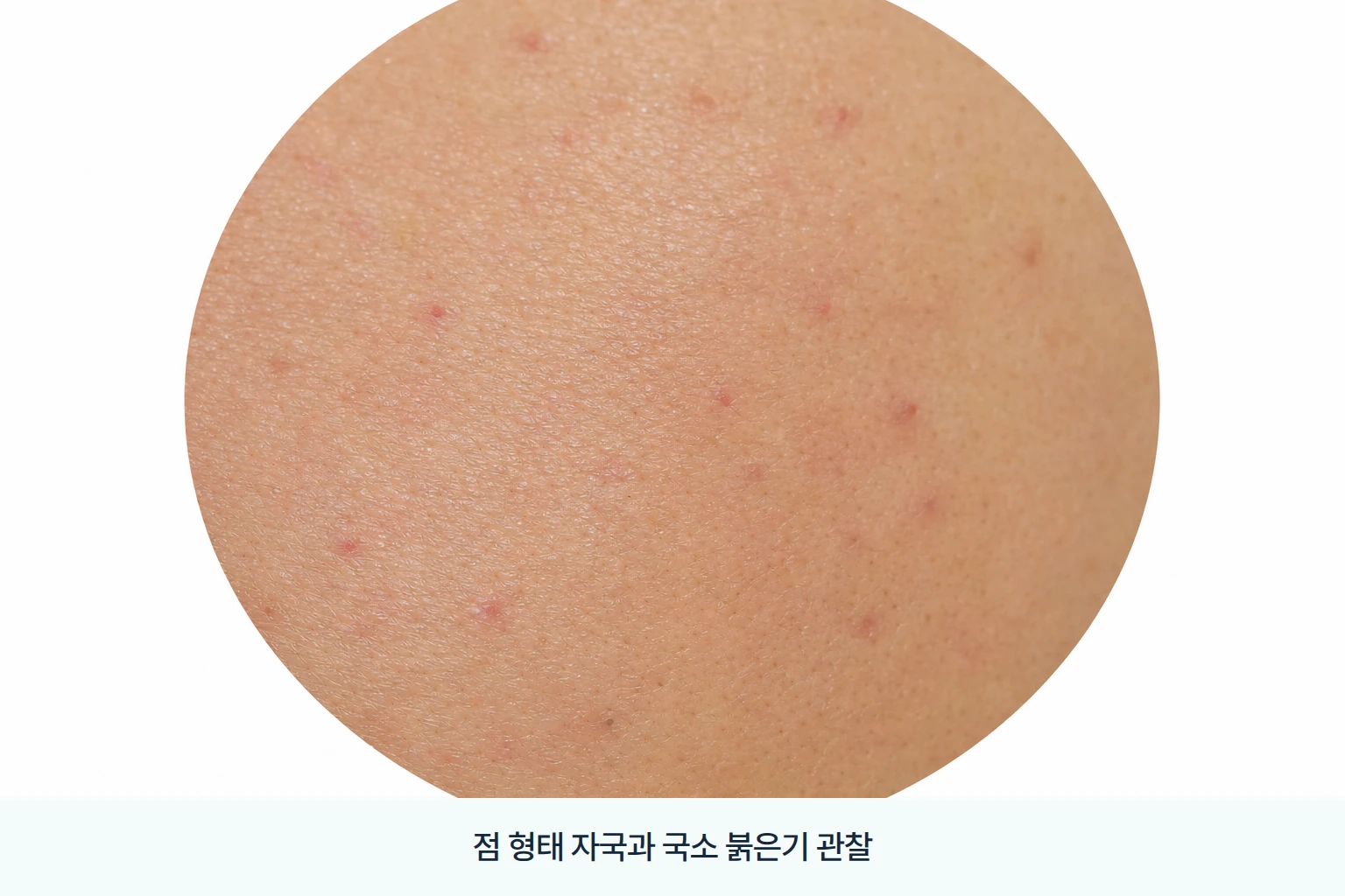 콜라겐주사 후 피부 표면의 붉은기와 점 형태 주사 자국
