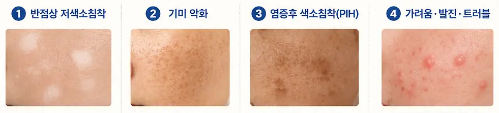 반점상 저색소침착·기미 악화·색소침착·발진 등 피코토닝 부작용 유형