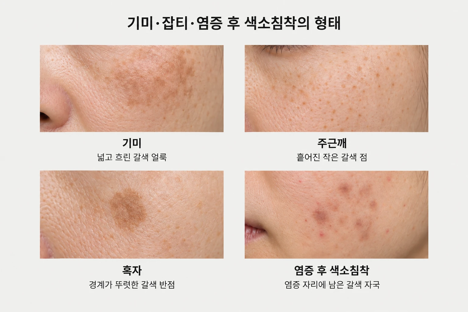 기미의 넓은 얼룩과 주근깨·흑자·염증 후 갈색 자국 비교