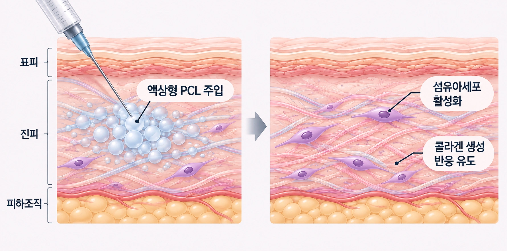 진피층에 고우리 액상형 PCL을 주입한 뒤 섬유아세포 활성화와 콜라겐 생성 반응이 유도되는 과정을 비교한 피부 단면도