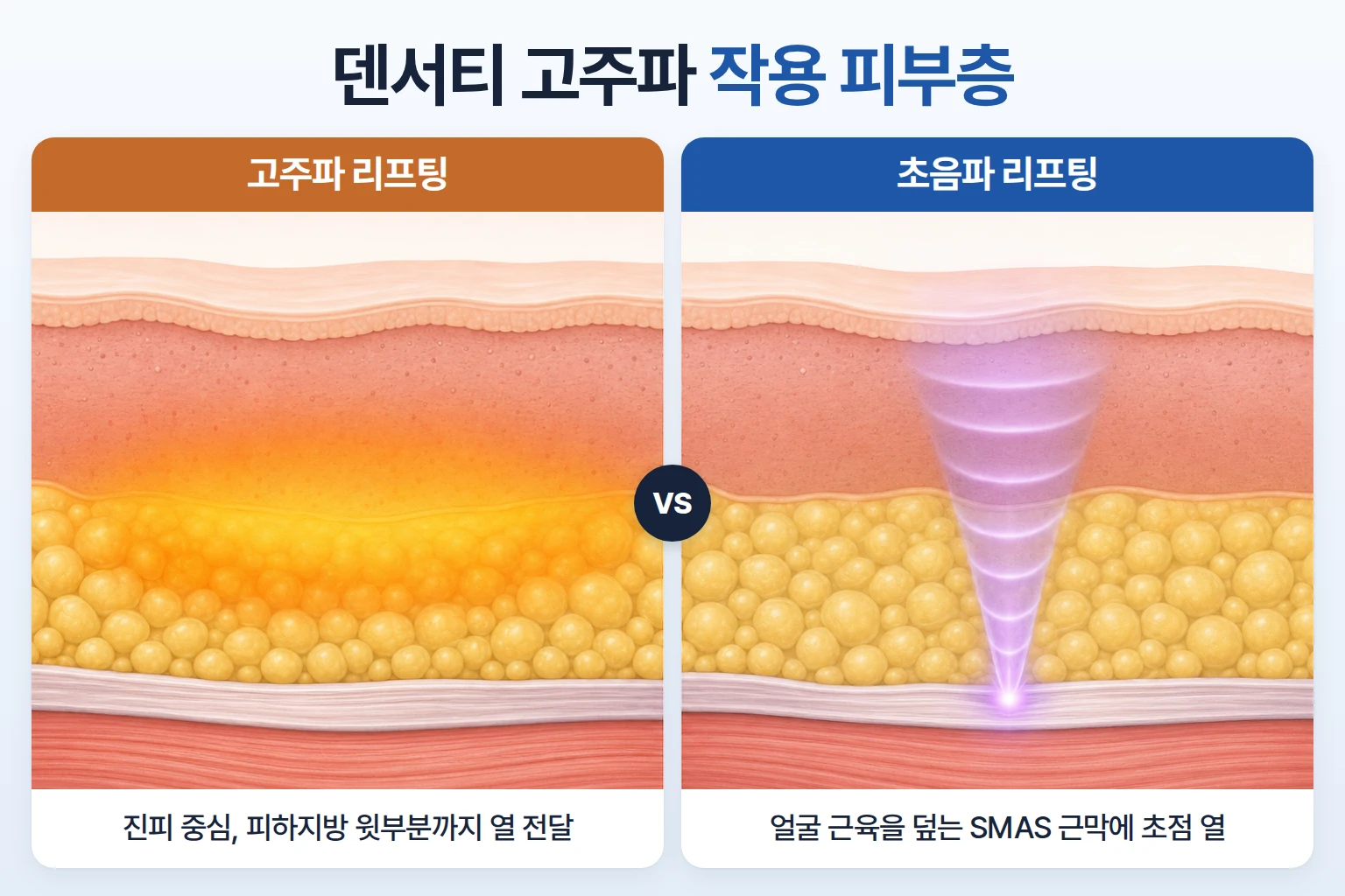 표피, 진피, 피하지방, 근막층에서 고주파와 초음파 열이 닿는 깊이를 비교한 단면 모식도