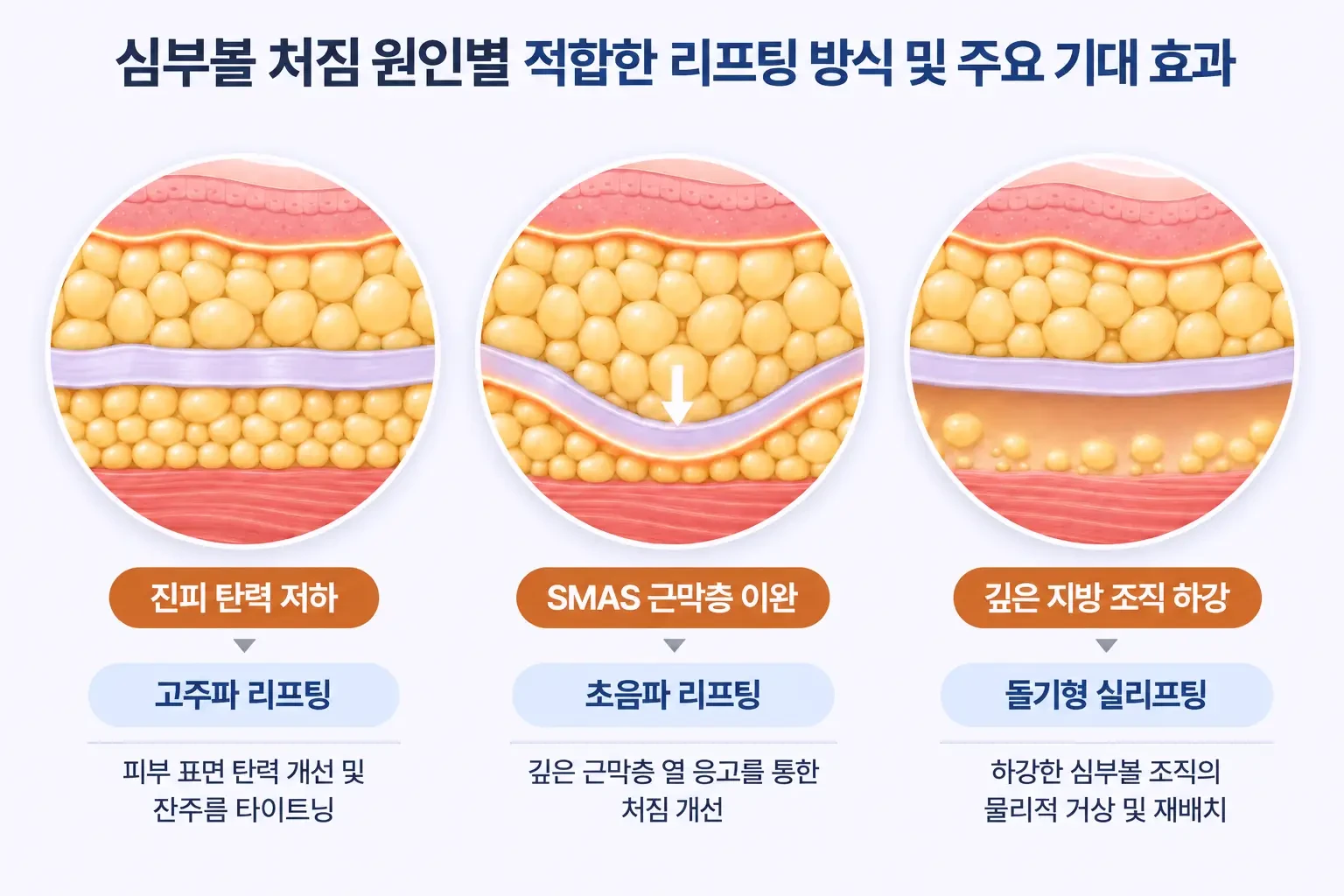 심부볼 처짐 원인별 고주파·초음파·실리프팅 방식과 기대 효과 비교