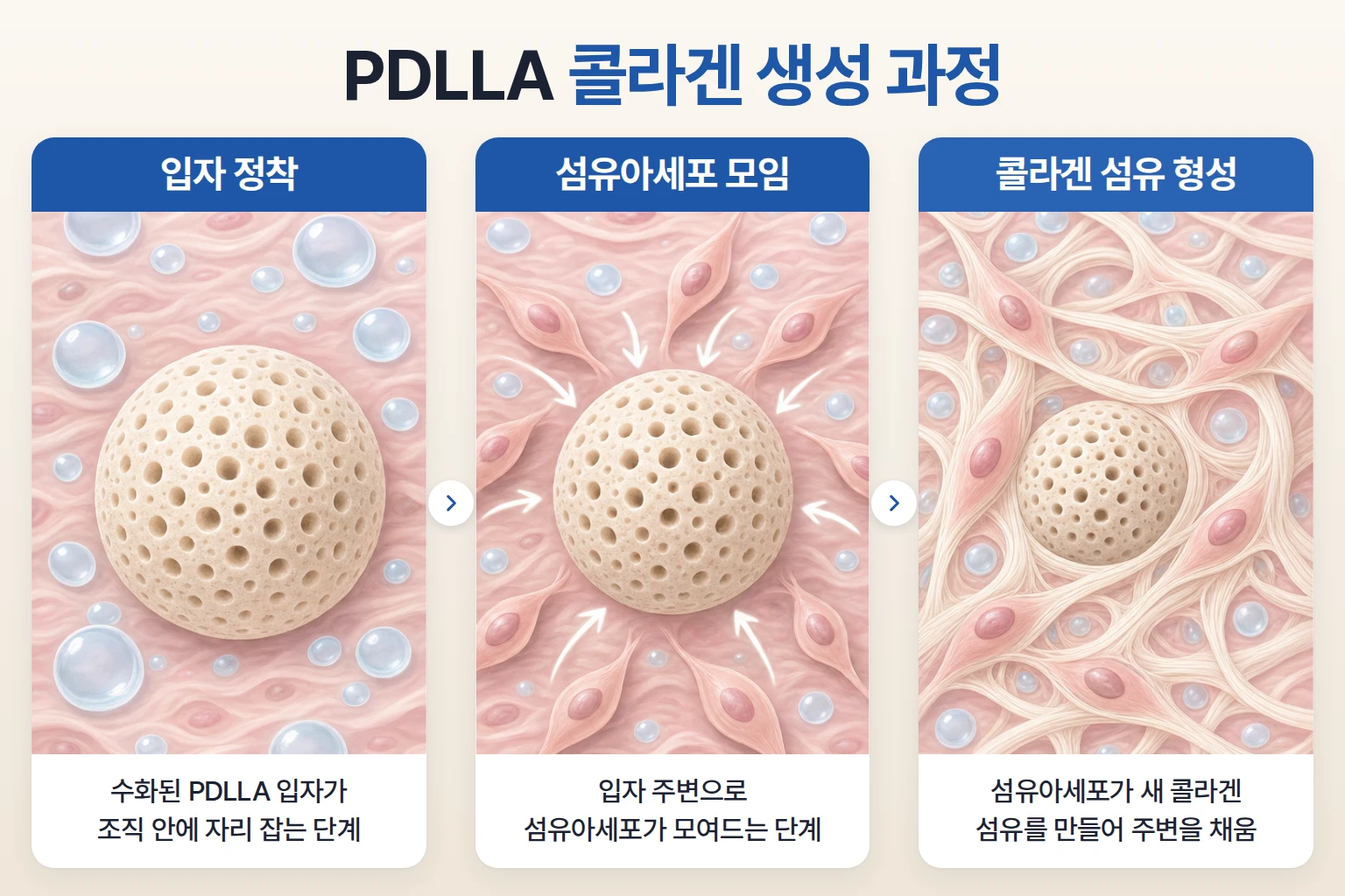 다공성 PDLLA 입자 주변에 섬유아세포가 모여 콜라겐 섬유를 만드는 과정을 나타낸 개념도