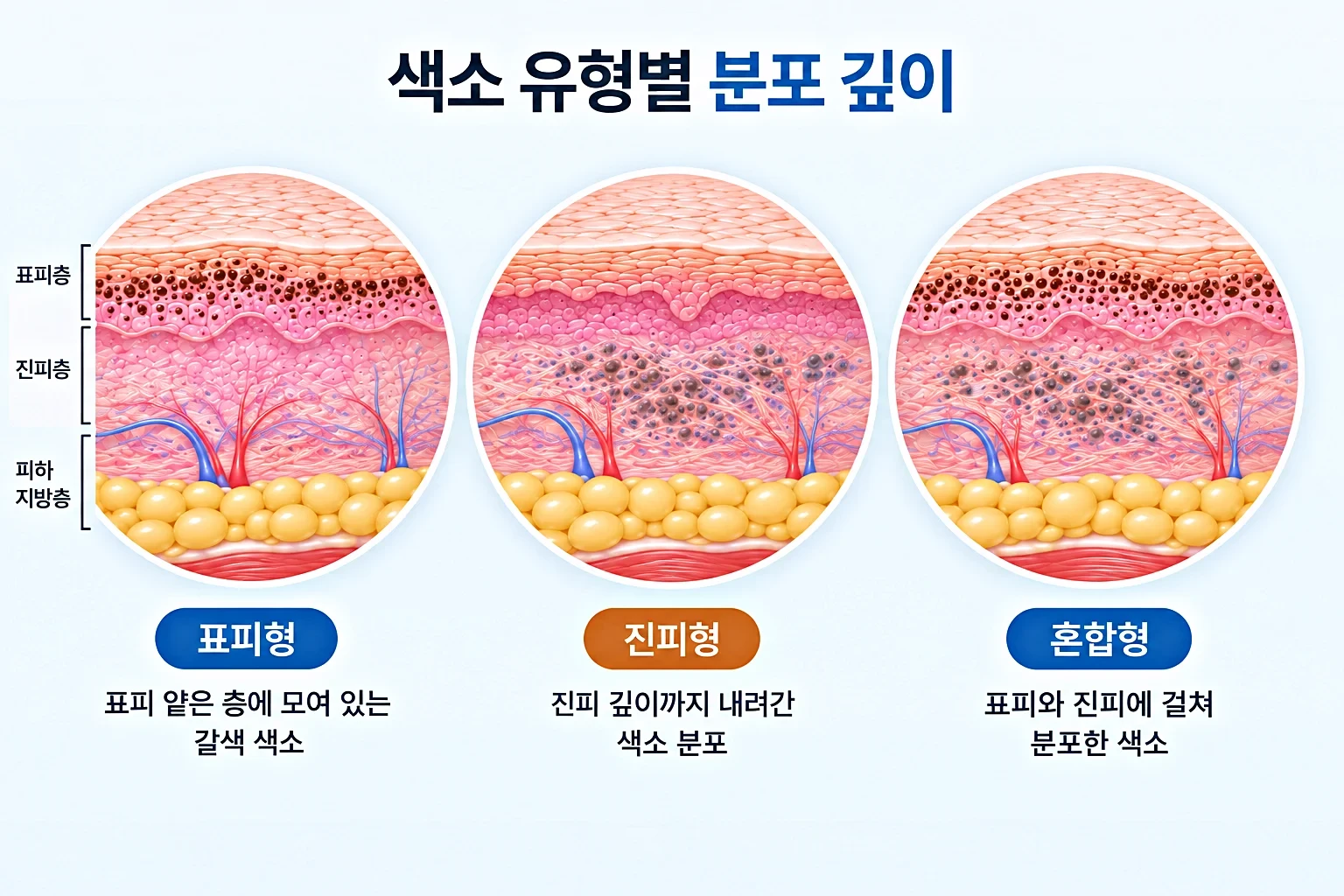 표피형, 진피형, 혼합형 색소의 분포 깊이를 동일 배율로 비교한 피부 단면 일러스트