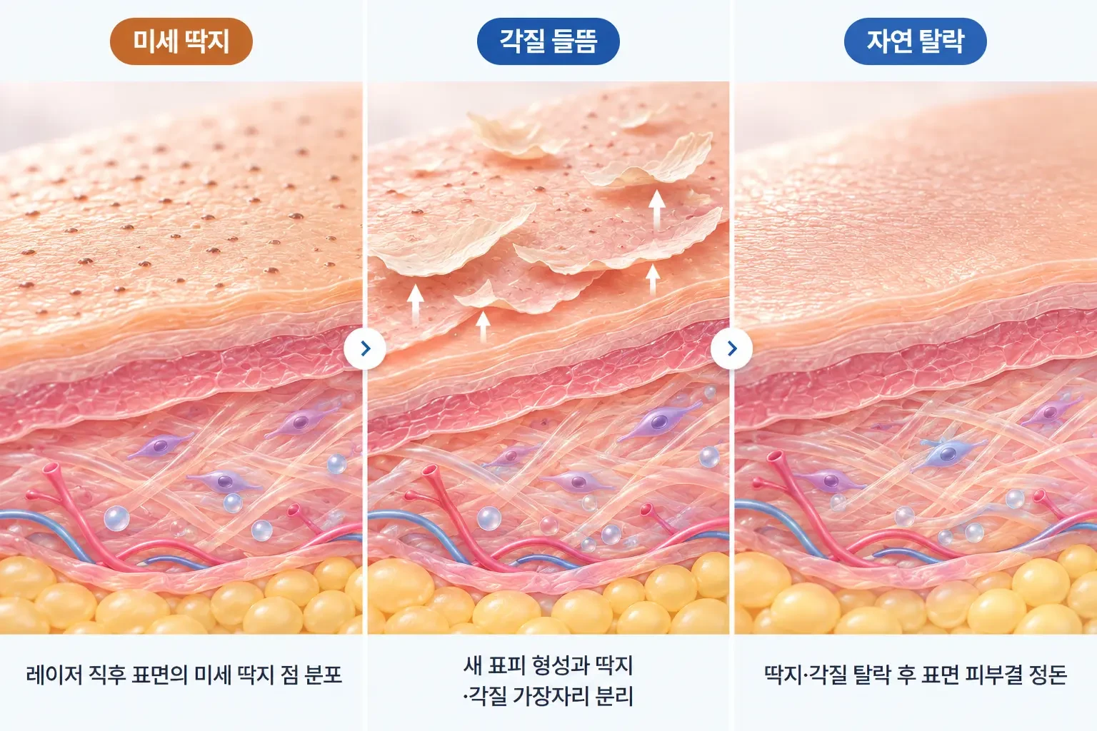레이저 후 생긴 미세 딱지와 각질이 들뜬 뒤 저절로 탈락하는 회복 과정을 확대한 일러스트