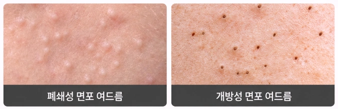 폐쇄성 면포와 개방성 면포의 모공 막힘 형태를 비교한 이미지