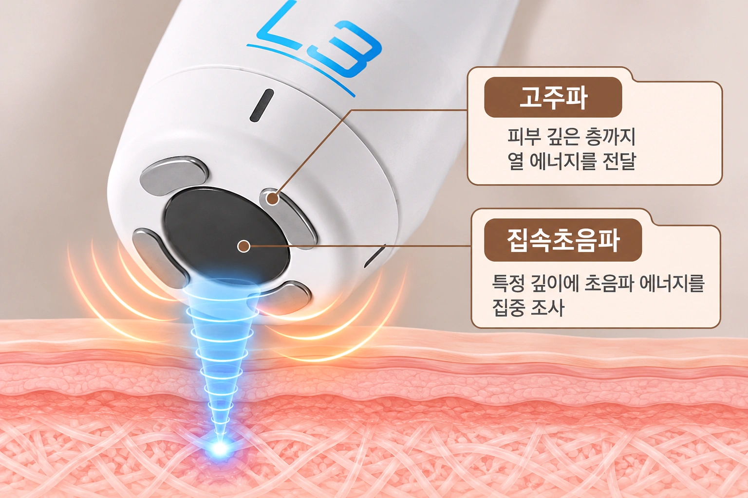 고주파와 집속초음파 에너지가 피부에 전달되는 방식과 브이로 어드밴스 핸드피스 구조를 설명한 의료 모식도