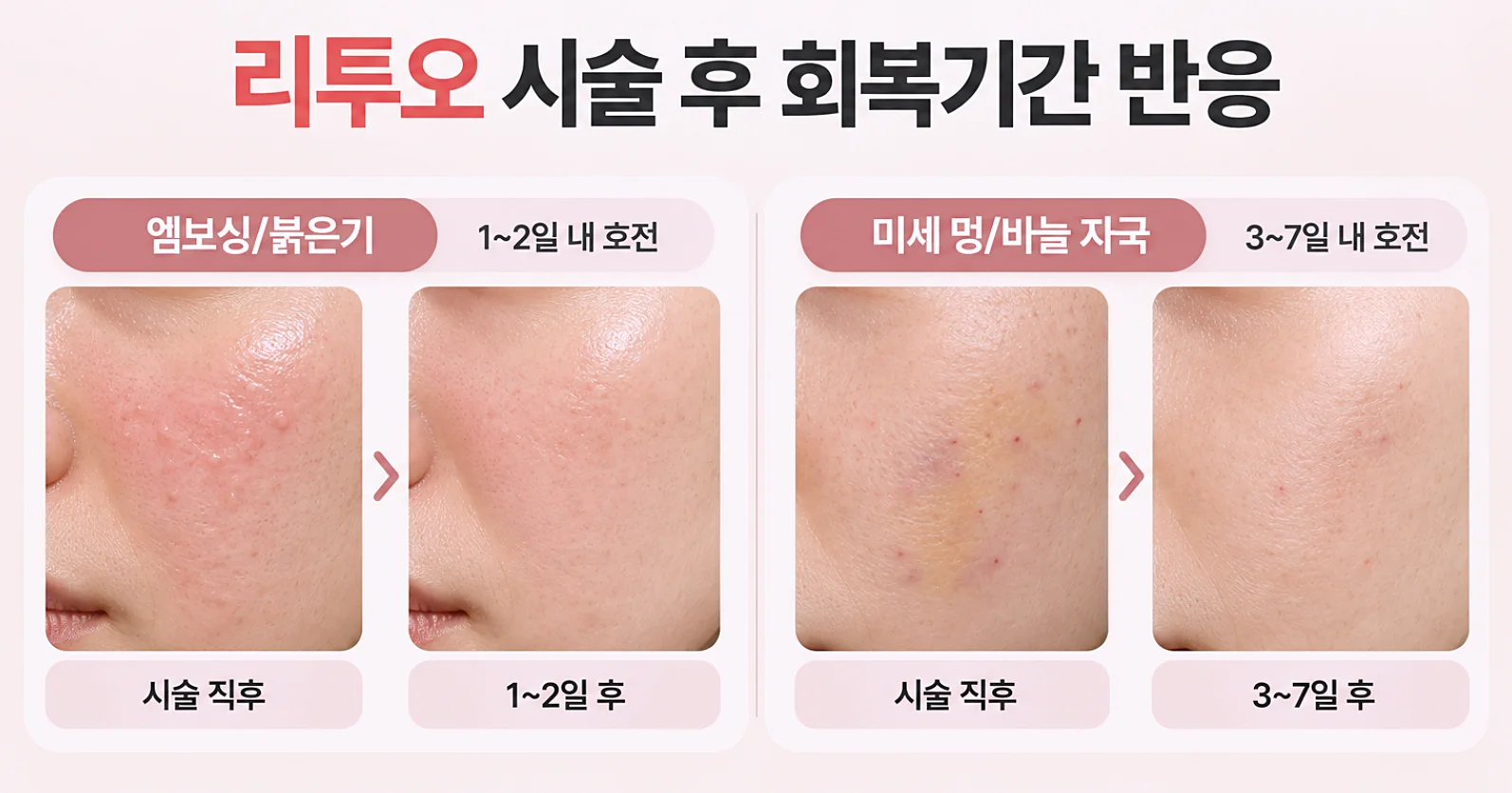 엘라비에 리투오 시술 후 회복기간 반응 - 엠보싱 붉은기 미세멍 바늘자국
