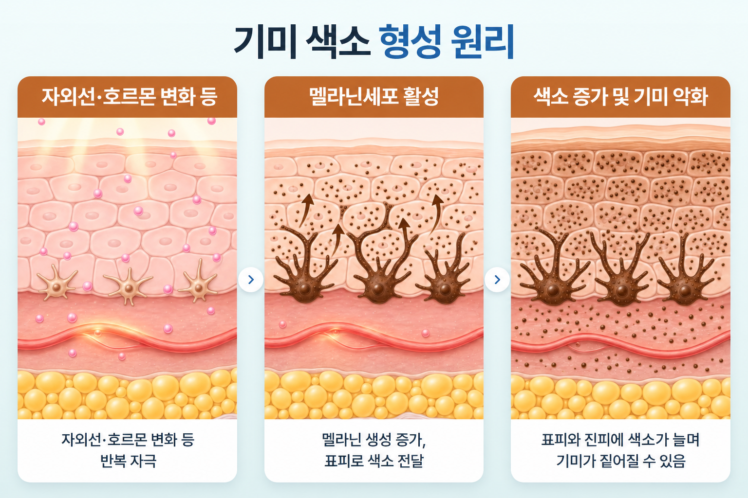 자외선과 호르몬 변화에 따른 멜라닌세포 활성, 멜라닌 생성 증가와 표피 내 색소 전달, 기미 색소가 증가하는 피부 단면 변화
