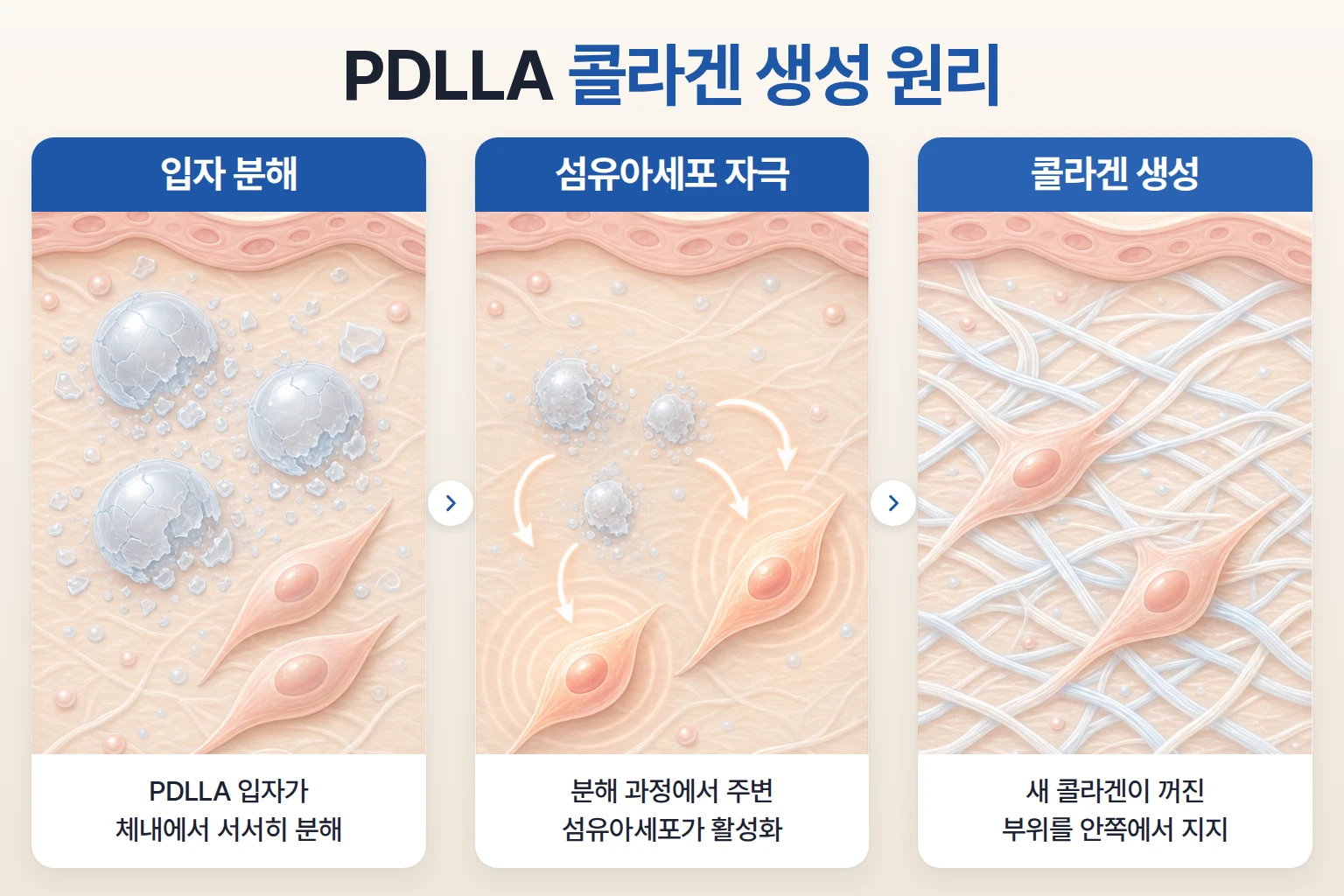 PDLLA 입자 분해, 섬유아세포 자극, 콜라겐 생성 과정을 단계별로 나타낸 확대 개념도