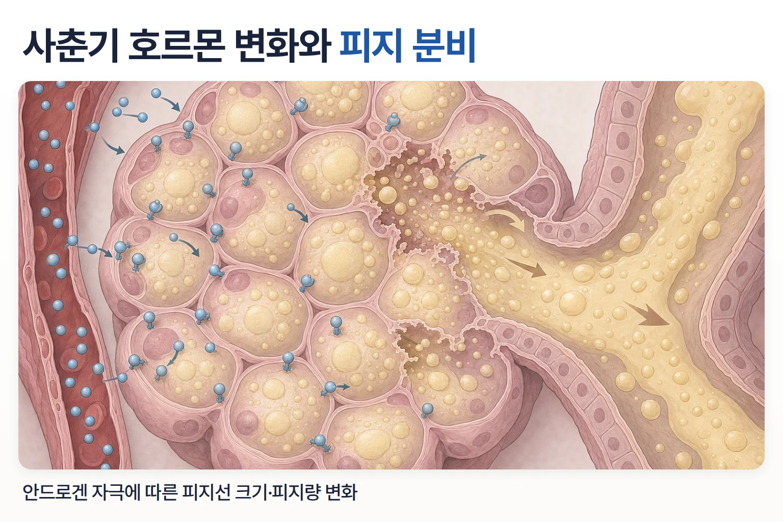 안드로겐 증가와 피지선 확대 그림