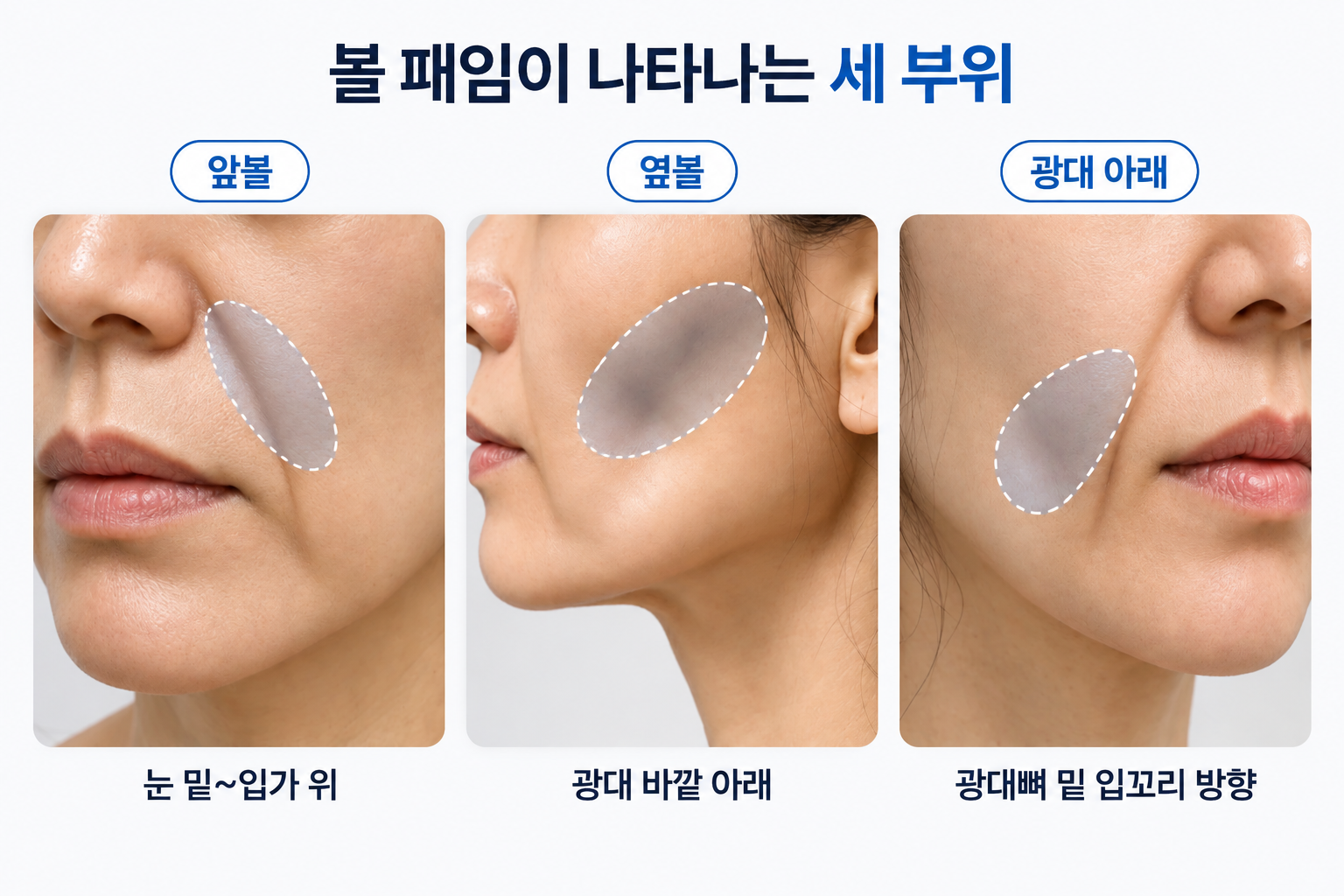 앞볼 옆볼 광대 아래로 구분한 볼 패임 주요 발생 부위