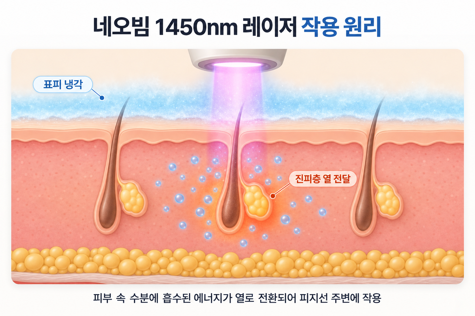 네오빔 1450nm 레이저 조사 시 표피 냉각과 함께 진피층 수분에 흡수된 에너지가 열로 전환되어 모공 주변 피지선에 작용하는 과정