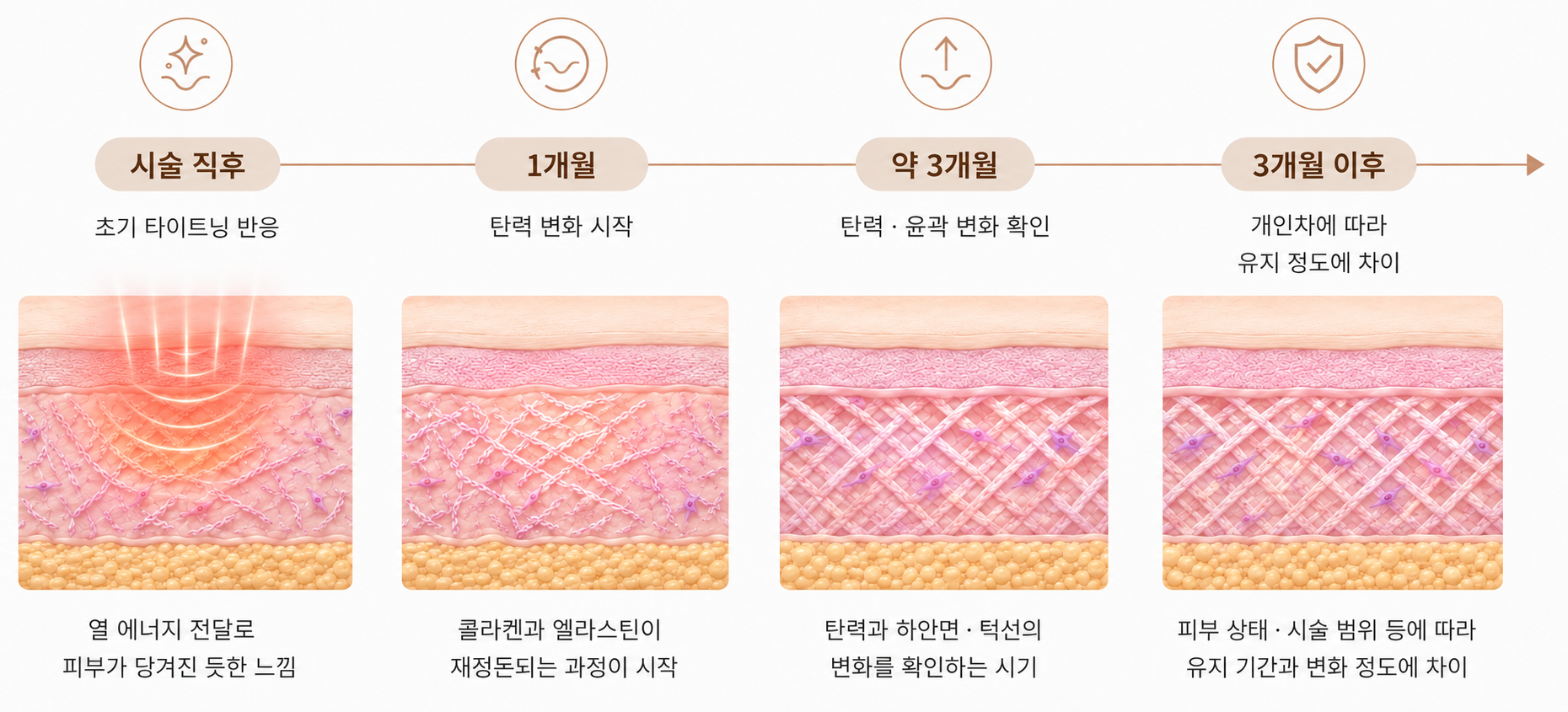 세르프 리프팅 효과가 시술 직후부터 수개월에 걸쳐 변화하는 과정을 보여주는 타임라인