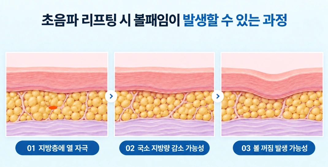 초음파 리프팅 시 지방층에 열이 전달되어 국소 지방량 감소와 볼패임이 발생할 수 있는 과정