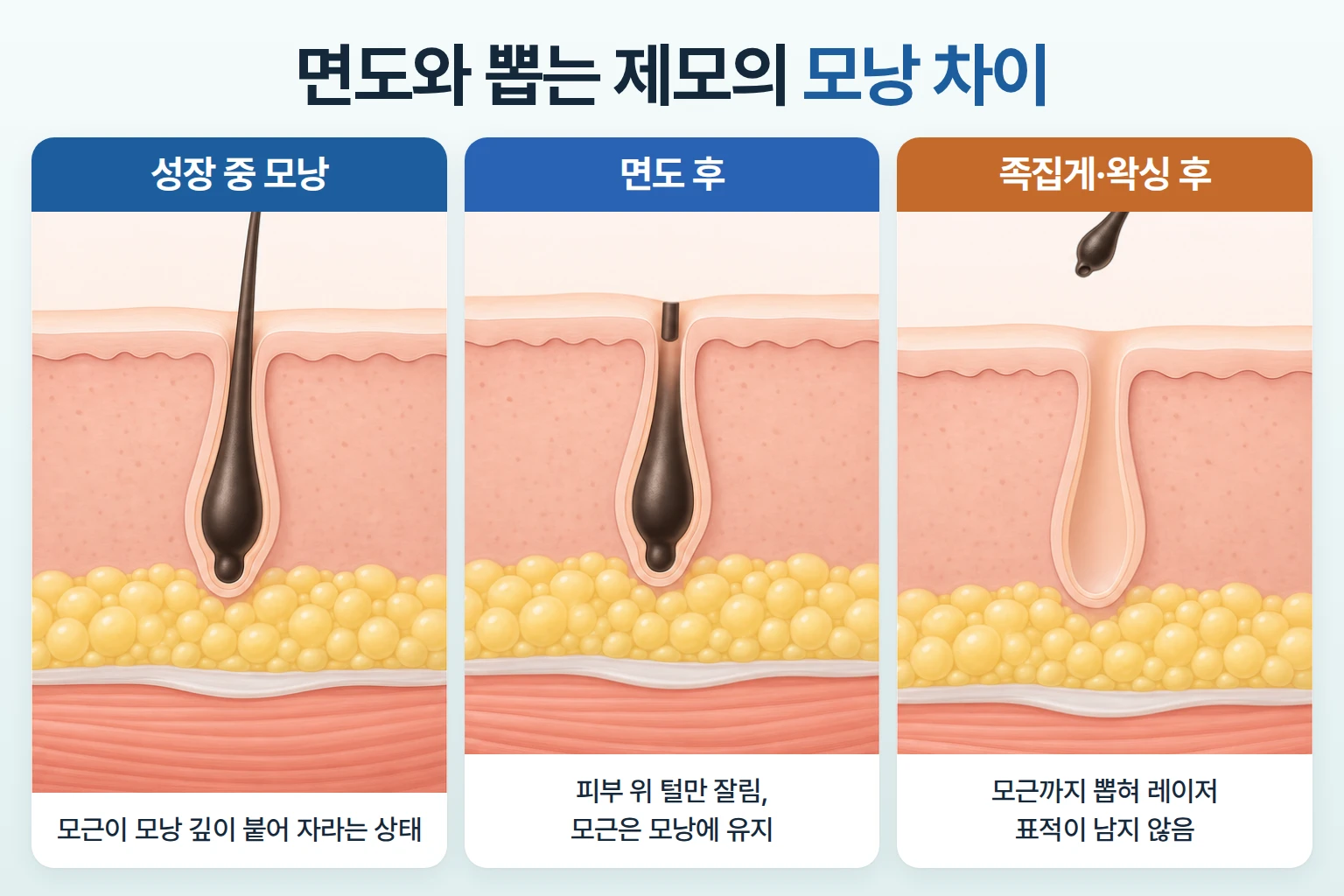 성장 중인 모낭, 면도 후 모근이 남은 모낭, 족집게로 모근이 빠진 모낭을 나란히 비교한 단면도