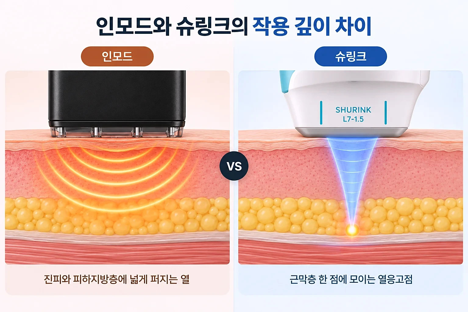 고주파 열 확산과 집속 초음파 열응고점 도달 깊이를 같은 배율로 비교한 피부 단면 도식