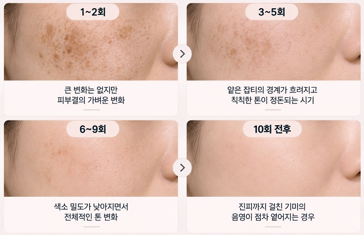 피코슈어 반복 시술 횟수에 따라 기미와 색소 밀도, 피부톤 변화 양상을 단계별로 비교한 이미지