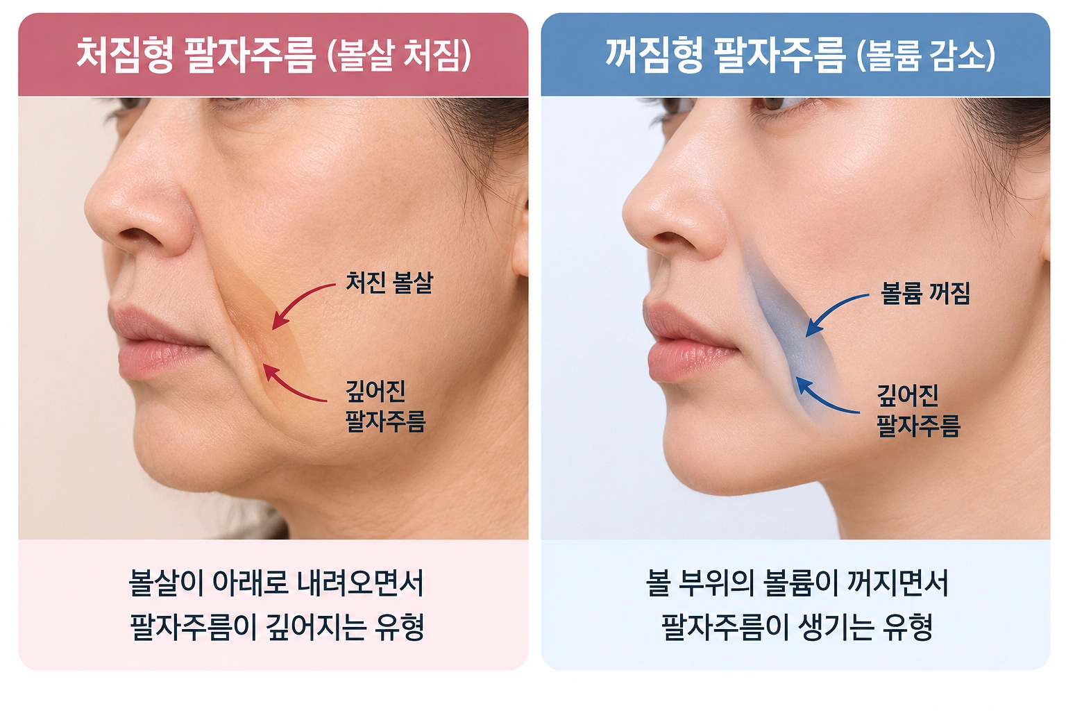 볼 처짐형과 볼륨 꺼짐형으로 구분하는 팔자주름 유형