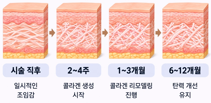 볼뉴머 시술 직후부터 2~4주, 1~3개월, 6~12개월까지 콜라겐 생성과 리모델링에 따른 변화를 단계별로 정리한 피부 단면도