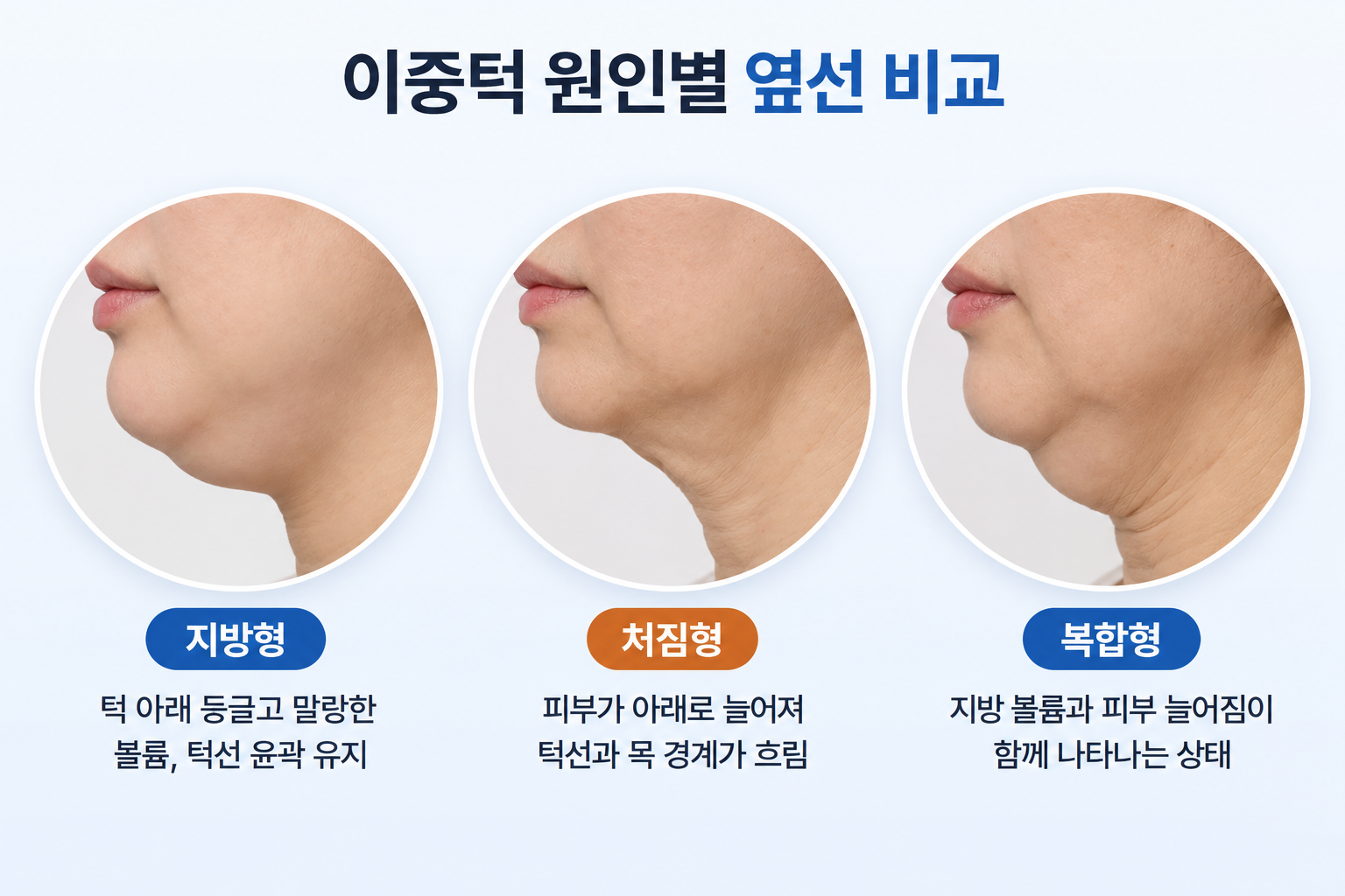 턱밑 살이 생기는 원인에 따른 지방형 처짐형 복합형의 턱선 차이
