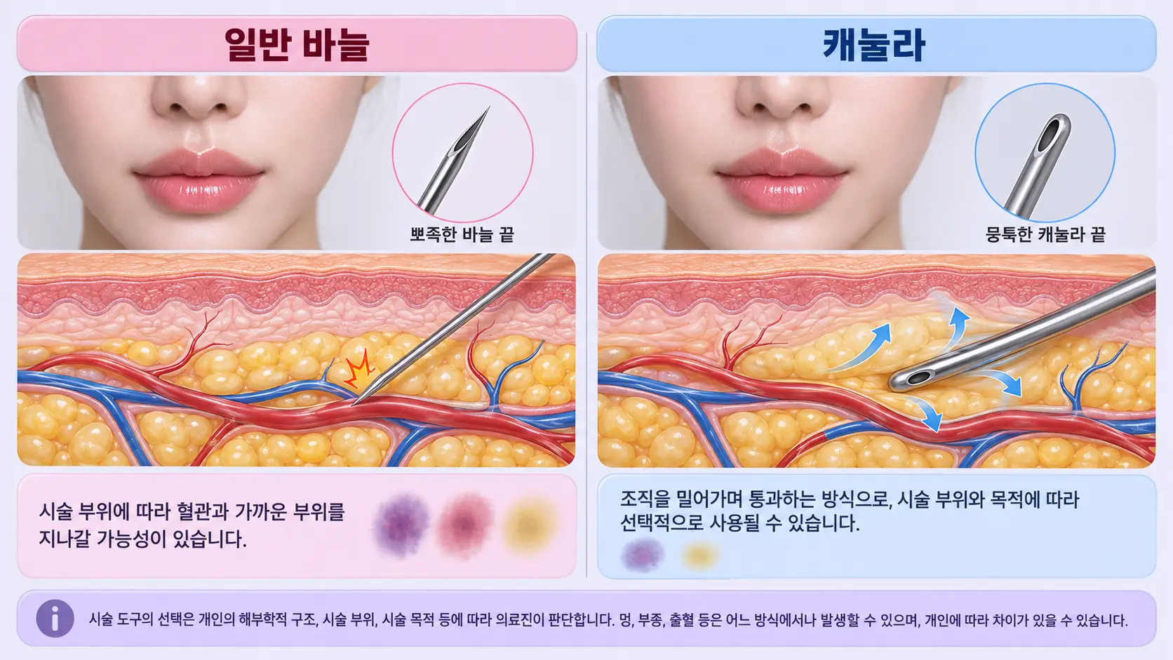 입술필러 시 캐뉼라를 사용하면 좋은 점