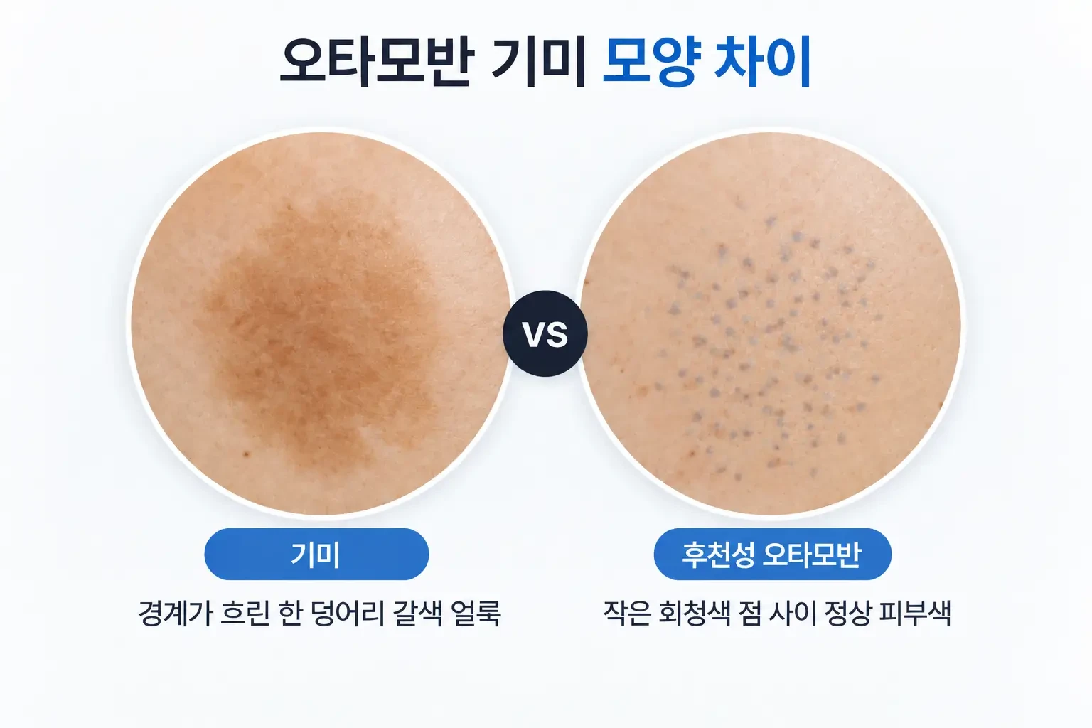 경계가 흐린 갈색 기미 얼룩과 작은 회청색 점이 모인 오타모반을 같은 배율로 비교한 피부 사진