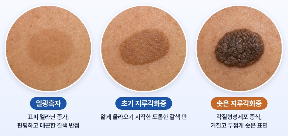 일광흑자와 초기 지루각화증, 솟은 지루각화증의 피부 표면 특징을 비교한 이미지